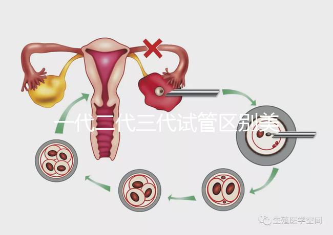 一代二代三代試管區(qū)別美琳達(dá)(一代二代三代試管區(qū)別及價(jià)格)