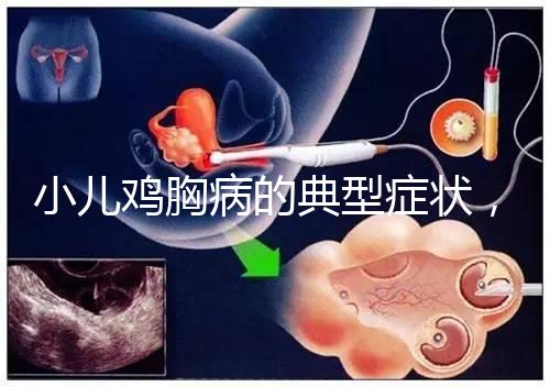 小兒雞胸病的典型癥狀，早發現早治療很重要！