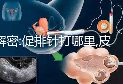 解密:促排針打哪里,皮下